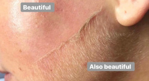 Golenie twarzy specjalnym skalpelem. Dlaczego kobiety na całym świecie oszalały na punkcie dermaplaningu?